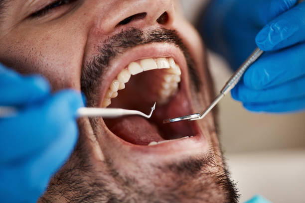 Best Root Canal Treatment  in Madisonville, TX